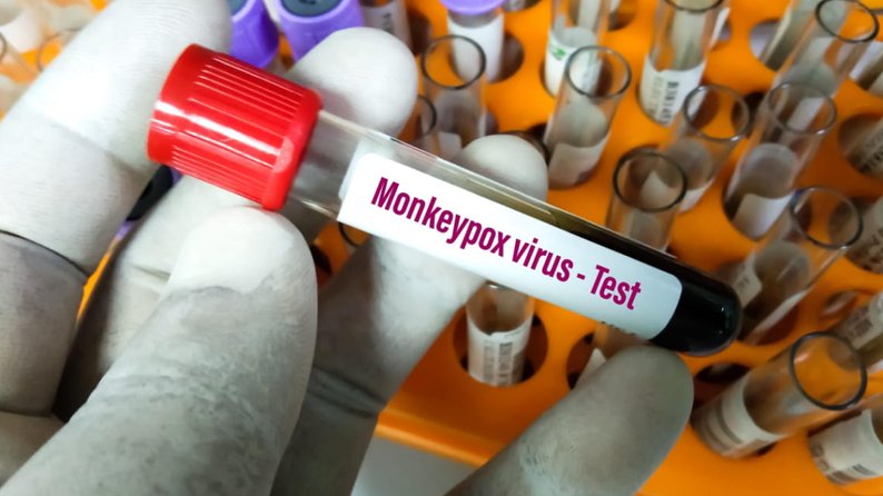 В Росії підтверджено перший випадок зараження вірусом мавпячої віспи, повідомила пресслужба Росспоживнагляду